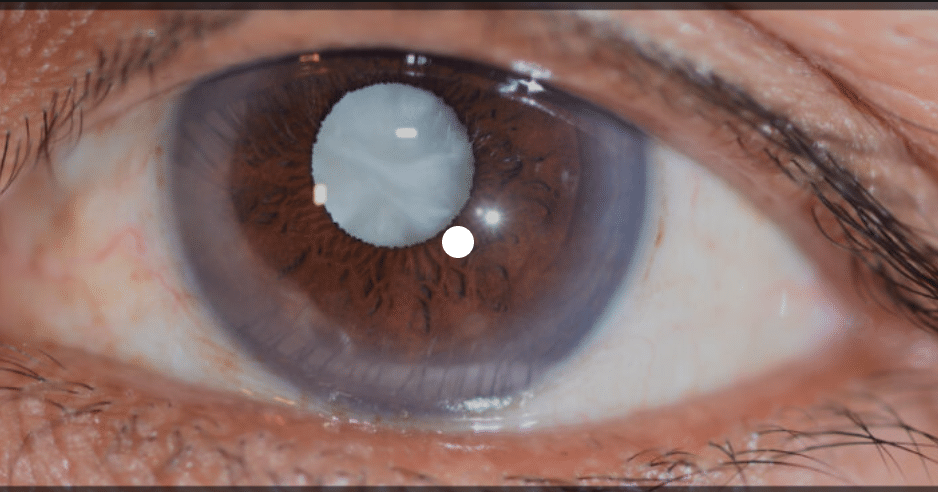 Cataract - Neilson Eyecare