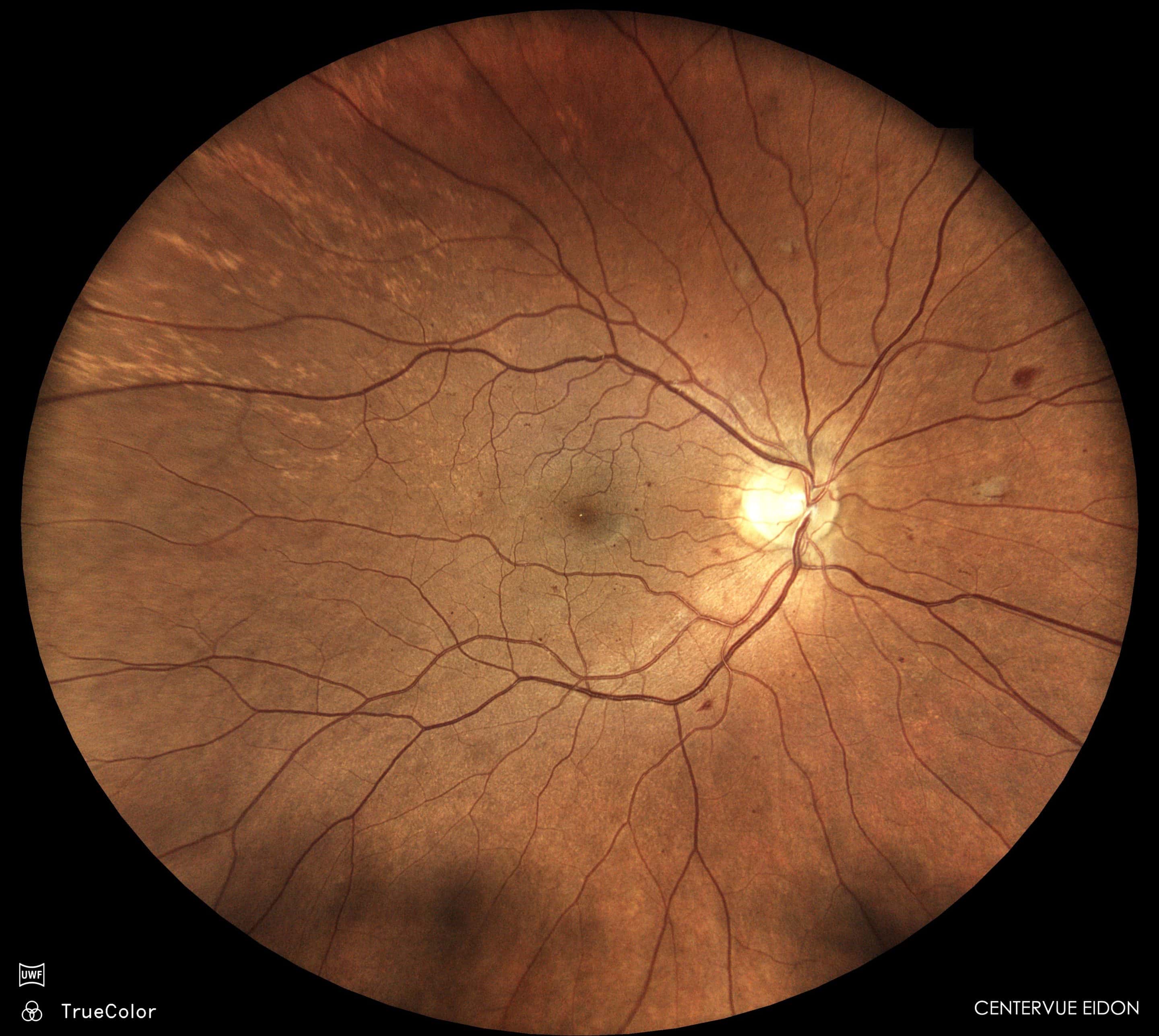 Diabetic retinopathy including haemorrhages in the retina (dark spots) - Neilson Eyecare