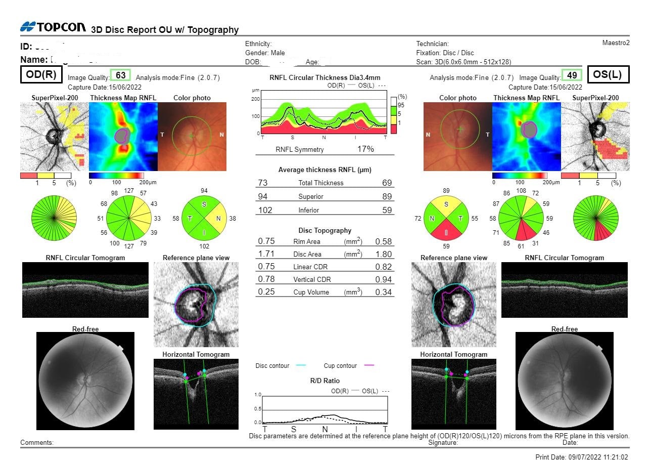 Glaucoma Exam Report - Neilson Eyecare