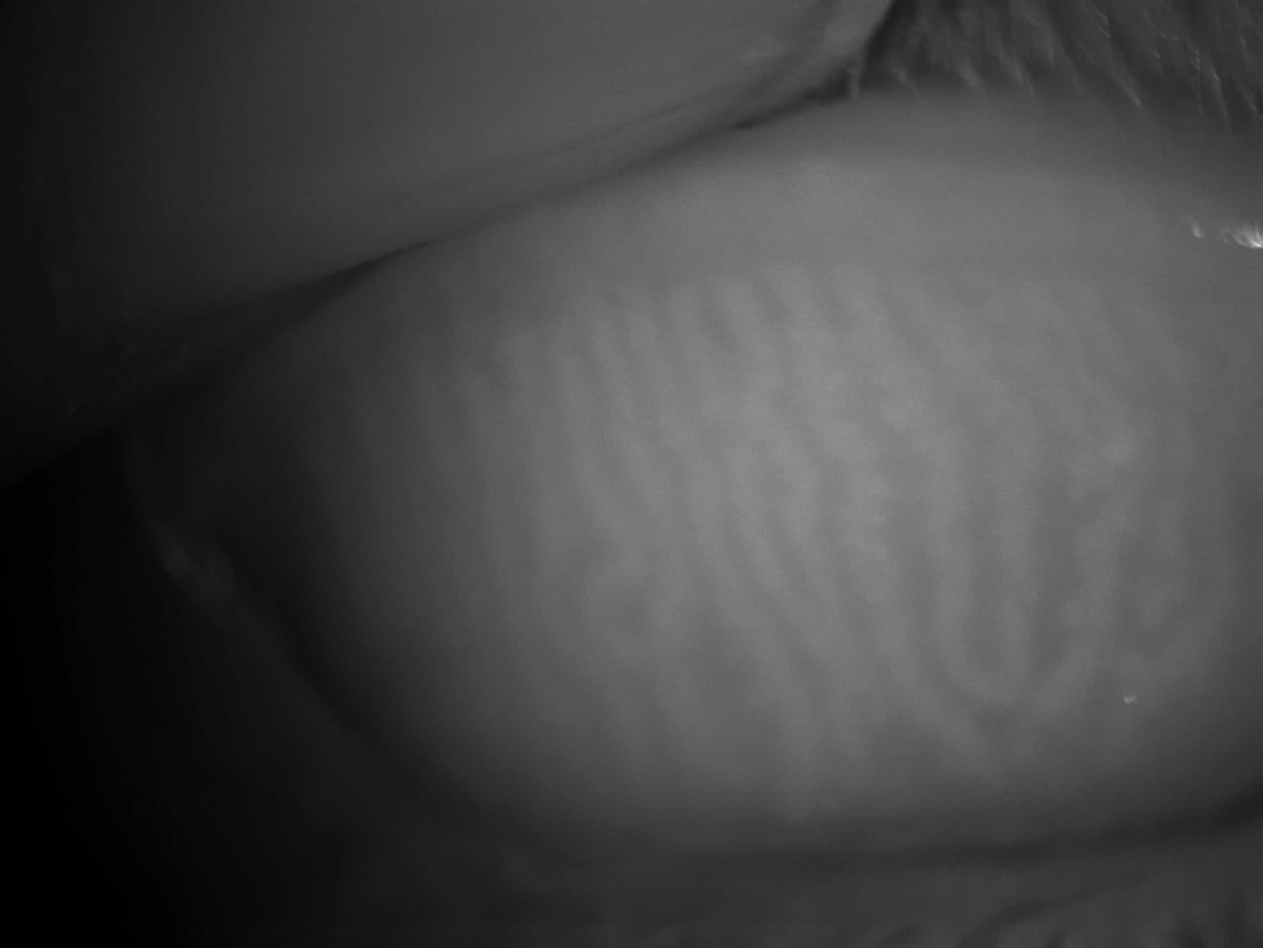 meibography image for Dry Eye assessment - Neilson Eyecare