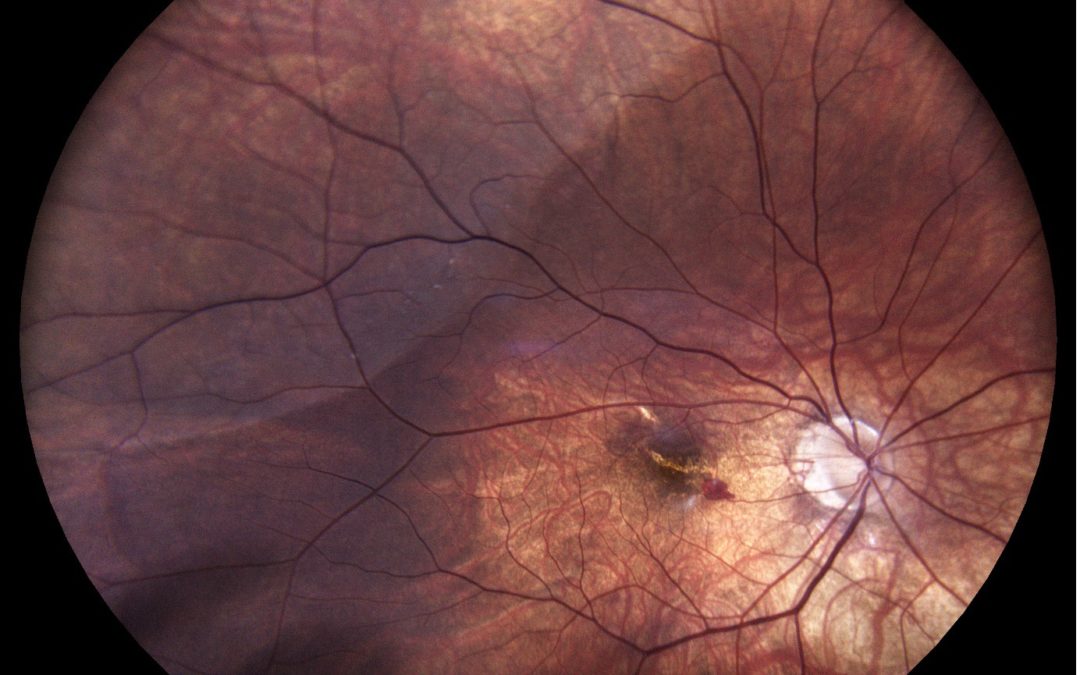 Retinal Detachment - Neilson Eyecare