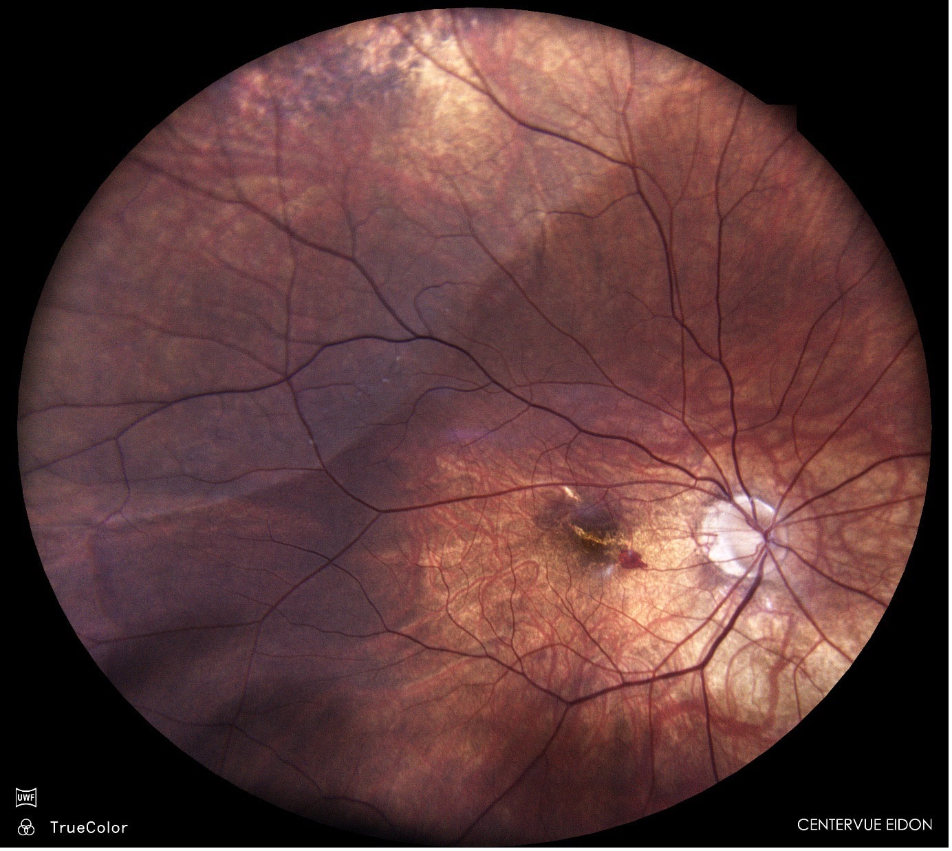Retinal Detachment - Neilson Eyecare